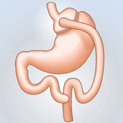 Gastric_Bypass