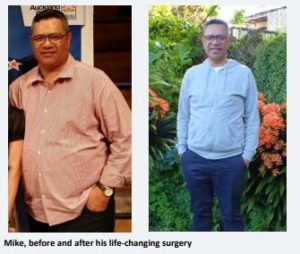 man before and after weightloss surgery