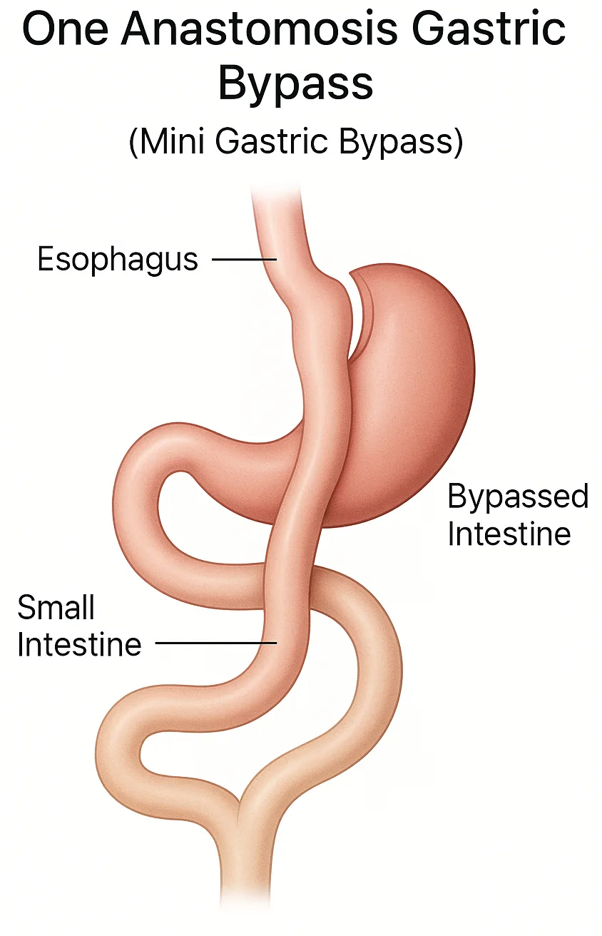 Mni gastric Bypass Diagram-Main