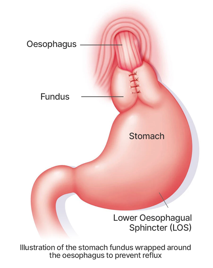 fundoplication diagram
