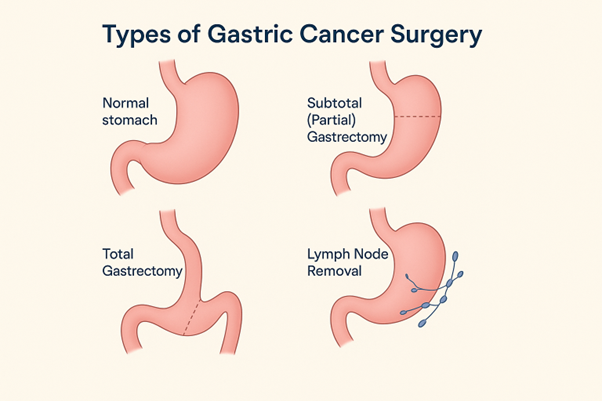 Types of Gastric Cancer